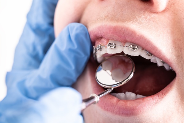 What Are Corrective Braces?