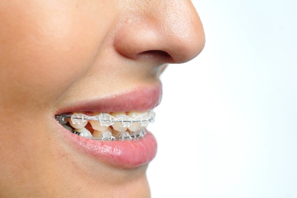 Clear Braces: What Makes A Good Candidate?