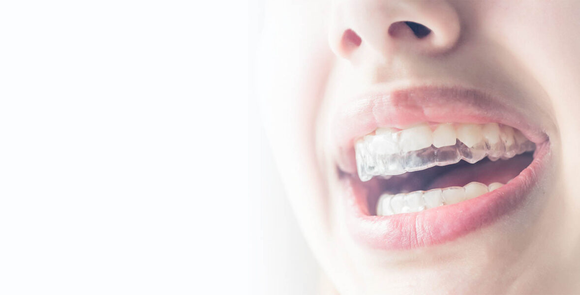 Clear Aligners